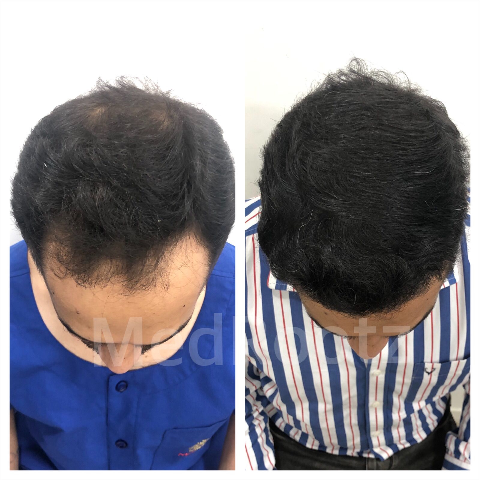 Best hair transplant doctor in delhi